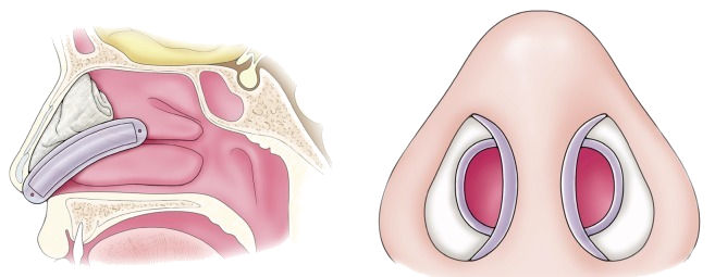 korea-rhinoplasty-center-instructions-for-after-your-surgery